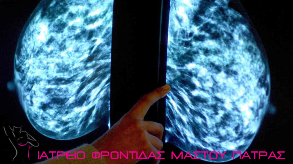 Πυκνός ινοκυστικός μαστός στην μαστογραφία - Ιατρείο Φροντίδας Μαστού Πάτρας Ιωάννης Χαβελές Μαστολόγος Χειρουργός Μαστού