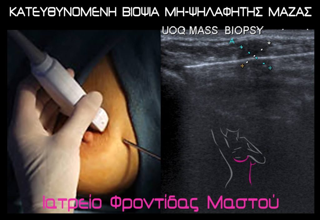 Βιοψία ογκιδίου μαστού υπέρηχος Ιατρείο Φροντίδας Μαστού Πάτρας Ιωάννης Χαβελές Μαστολόγος Χειρουργός μαστού Βιοψία ογκιδίου μαστού υπέρηχος Ιατρείο Φροντίδας Μαστού Πάτρας Ιωάννης Χαβελές Μαστολόγος Χειρουργός μαστού