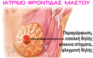 συμπτώματα καρκίνος μαστού, εισολκή θηλής, ιατρείο μαστού πατρα, φροντίδα μαστού, χαβελές ιωάννης χειρουργός μαστού μαστολόγος