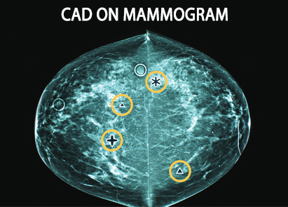 CAD ψηφιακή μαστογραφία