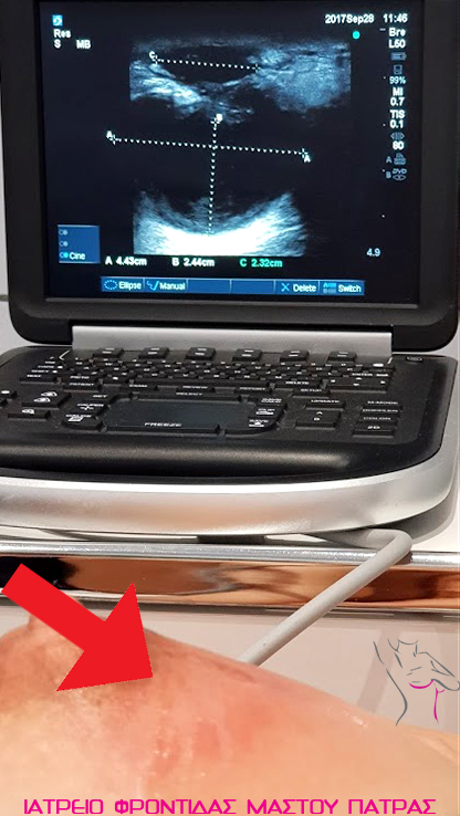 Έτοιμοι για κατευθυνόμενη παρακέντηση μεγάλων αποστημάτων από παραμελημένη μαστίτιδα γαλουχίας