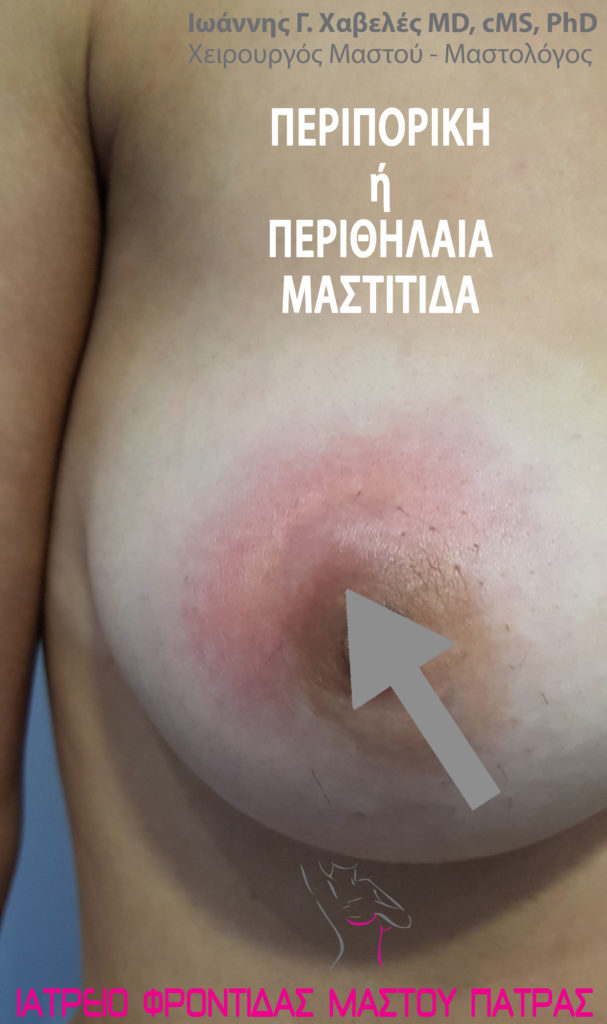 Περιπορική ή Περιθηλαία Μαστίτιδα, Ιωάννης Χαβελές Χειρουργός Μαστού Μαστολόγος, Ιατρείο Φροντιδας Μαστού Πάτρας Περιπορική ή Περιθηλαία Μαστίτιδα, Ιωάννης Χαβελές Χειρουργός Μαστού Μαστολόγος, Ιατρείο Φροντιδας Μαστού Πάτρας