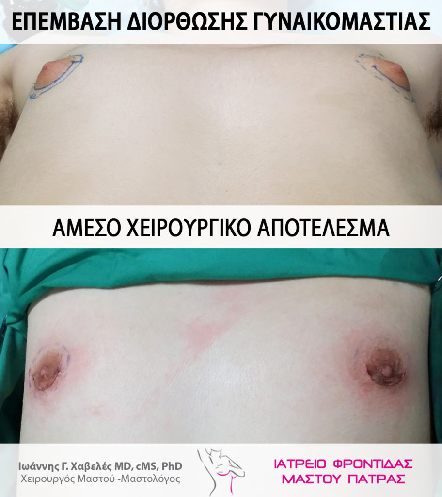 Χειρουργική επέμβαση υποδόρια μαστεκτομή για γυναικομαστία Ιωάννης Χαβελές Χειρουργός Μαστού Χειρουργική επέμβαση υποδόρια μαστεκτομή για γυναικομαστία Ιωάννης Χαβελές Χειρουργός Μαστού